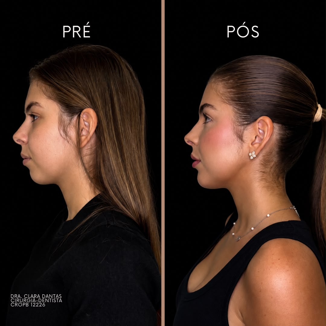 Pré e pós de contorno mandibular