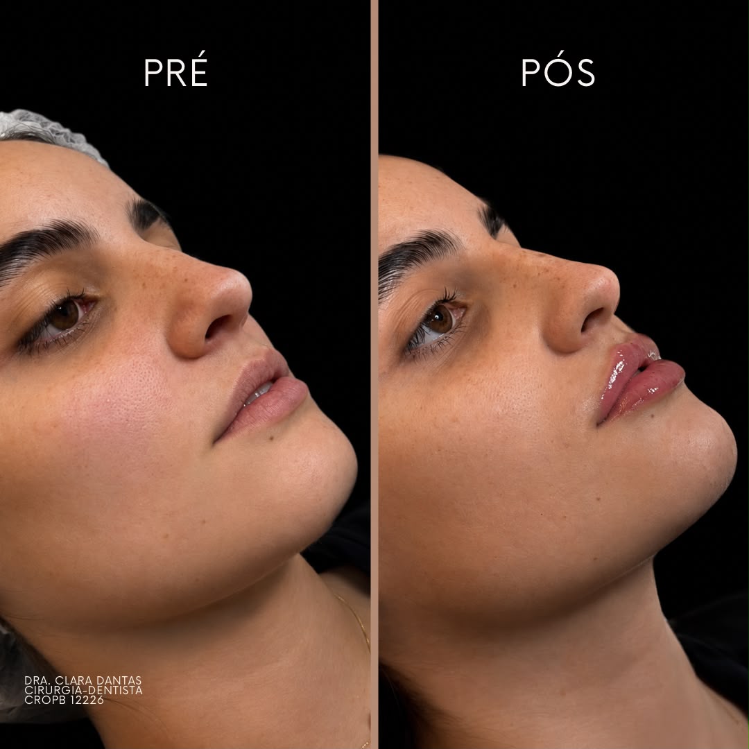 Pré e pós de preenchimento labial